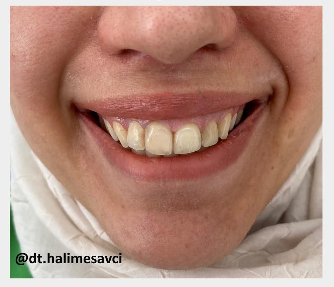 Gummy Smile Tedavisi Sonrası - Özel Astro Dent Ağız ve Diş Sağlığı Kliniği, Mardin